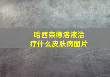 哈西奈德溶液治疗什么皮肤病图片